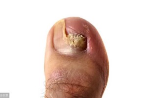 5种治疗灰指甲常用药物详解